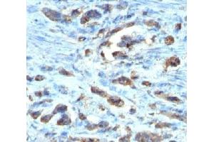 IHC testing of FFPE gastric carcinoma with Cdc20 antibody (clone AR12) (CDC20 antibody)