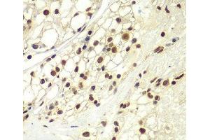 Immunohistochemistry of paraffin-embedded Human kidney cancer using RPA2 Polyclonal Antibody at dilution of 1:100 (40x lens). (RPA2 antibody)