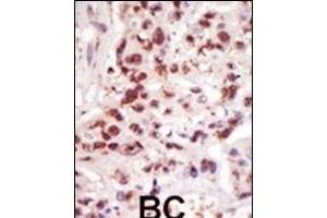 Formalin-fixed and paraffin-embedded human cancer tissue reacted with the primary antibody, which was peroxidase-conjugated to the secondary antibody, followed by DAB staining. (MAP3K8 antibody  (C-Term))