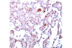 Immunohistochemistry of paraffin-embedded human breast carcinoma using Phospho-RELA-S536 antibody (ABIN2987368). (NF-kB p65 antibody  (pSer536))