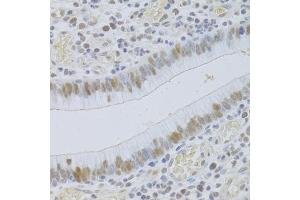 Immunohistochemistry of paraffin-embedded human gastric cancer using JMJD6 Antibody (ABIN5973452) at dilution of 1/100 (40x lens). (JMJD6 antibody)