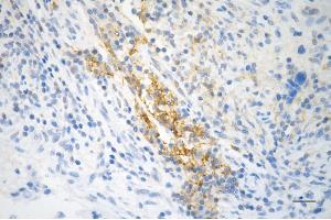 Immunohistochemistry was performed on paraffin-embedded human breast carcinoma using STAT5A antibody (ABIN7800347), 1:200). (Recombinant STAT5A antibody)