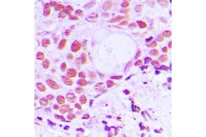Immunohistochemical analysis of TIF1 alpha staining in human breast cancer formalin fixed paraffin embedded tissue section. (TRIM24 antibody  (C-Term))