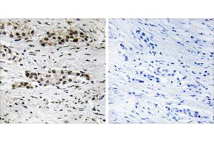 P-peptide - +Immunohistochemistry analysis of paraffin-embedded human breast carcinoma tissue using Estrogen Receptor-α (Phospho-Ser102) antibody. (Estrogen Receptor alpha antibody  (pSer102))