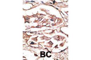Formalin-fixed and paraffin-embedded human cancer tissue reacted with DKK2 polyclonal antibody  , which was peroxidase-conjugated to the secondary antibody, followed by AEC staining. (DKK2 antibody  (C-Term))