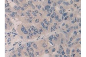 Detection of SMC3 in Human Breast cancer Tissue using Polyclonal Antibody to Structural Maintenance Of Chromosomes Protein 3 (SMC3) (SMC3 antibody  (AA 994-1181))