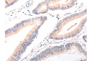 The image on the left is immunohistochemistry of paraffin-embedded Human colon cancer tissue using ABIN7189634(ACR Antibody) at dilution 1/20, on the right is treated with synthetic peptide. (Acrosin antibody)
