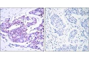 Immunohistochemistry analysis of paraffin-embedded human breast carcinoma tissue, using NF-kappaB p65 (Ab-468) Antibody. (NF-kB p65 antibody  (AA 435-484))