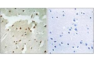 Immunohistochemistry analysis of paraffin-embedded human lung carcinoma, using Ku70 (Phospho-Ser5) Antibody. (XRCC6 antibody  (pSer5))