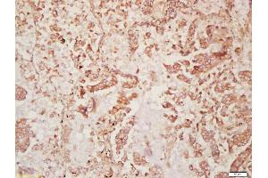 Formalin-fixed and paraffin embedded human lung carcinoma labeled with Anti-DISP2 Polyclonal Antibody, Unconjugated (ABIN1386087) at 1:200 followed by conjugation to the secondary antibody and DAB staining (DISP2 antibody  (AA 1101-1200))