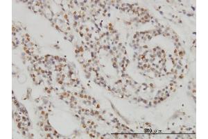 Immunoperoxidase of monoclonal antibody to DPF2 on formalin-fixed paraffin-embedded human ovary, clear cell carcinoma.