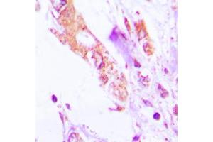 Immunohistochemical analysis of IL-1 beta staining in human lung cancer formalin fixed paraffin embedded tissue section.
