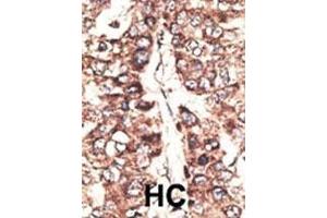 Formalin-fixed and paraffin-embedded human cancer tissue reacted with the primary antibody, which was peroxidase-conjugated to the secondary antibody, followed by DAB staining. (MAGEA11 antibody  (N-Term))