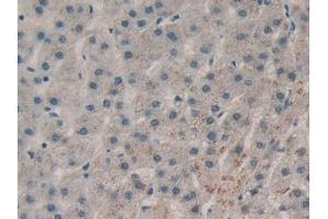 DAB staining on IHC-P; Samples: Human Liver cancer Tissue (RNASE1 antibody  (AA 29-156))