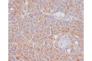 Immunohistochemical analysis of paraffin-embedded human lung cancer, using ATG9A Antibody. (Recombinant ATG9A antibody)
