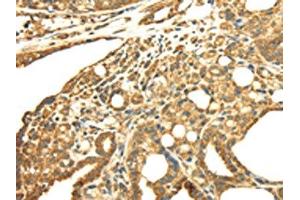 The image on the left is immunohistochemistry of paraffin-embedded Human thyroid cancer tissue using ABIN7128021(SRPRB Antibody) at dilution 1/30, on the right is treated with fusion protein. (SRPRB antibody)