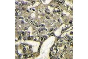IHC analysis of FFPE human breast carcinoma stained with AKT1 antibody (AKT1 antibody  (AA 115-144))