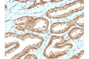 Formalin-fixed, paraffin-embedded human Prostate Carcinoma stained with YBX1 Mouse Recombinant Monoclonal Antibody (rYBX1/2430). (Recombinant YBX1 antibody)