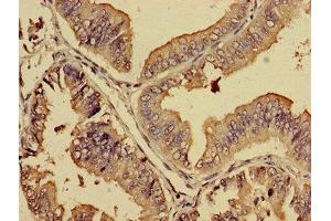Immunohistochemistry of paraffin-embedded human endometrial cancer using ABIN7164730 at dilution of 1:100 (PREB antibody  (AA 98-283))