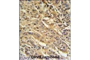 F91A1 Antibody (N-term) (ABIN651217 and ABIN2840136) IHC analysis in formalin fixed and paraffin embedded human cervix carcinoma followed by peroxidase conjugation of the secondary antibody and DAB staining. (FAM91A1 antibody  (N-Term))