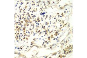 Immunohistochemistry of paraffin-embedded human liver cancer using UPF1 antibody.