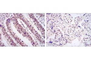 Immunohistochemical analysis of paraffin-embedded rectum cancer tissues (left) and placenta tissues (right) using CDK9 mouse mAb with DAB staining. (CDK9 antibody)