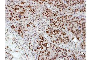 IHC-P Image Immunohistochemical analysis of paraffin-embedded NCIN87 xenograft, using hnRNP H, antibody at 1:100 dilution. (HNRNPH1 antibody)