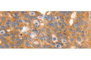 Immunohistochemistry of paraffin-embedded Human ovarian cancer tissue using MYOD1 Polyclonal Antibody at dilution of 1:120(x200) (MYOD1 antibody)