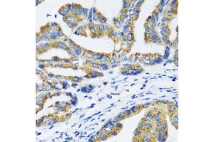Immunohistochemistry of paraffin-embedded human gastric cancer using NFKB1 antibody (ABIN6292205) at dilution of 1:100 (40x lens). (NFKB1 antibody)