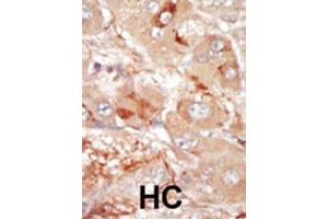 Formalin-fixed and paraffin-embedded human cancer tissue reacted with the primary antibody, which was peroxidase-conjugated to the secondary antibody, followed by DAB staining. (PRPF4B antibody  (C-Term))