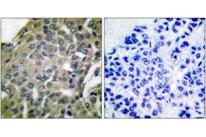 Immunohistochemistry analysis of paraffin-embedded human breast carcinoma tissue, using GRP94 Antibody. (GRP94 antibody  (AA 754-803))