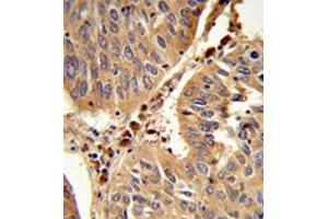 Formalin-fixed and paraffin-embedded human lung carcinoma reacted with Peroxin 16 / PEX16 Antibody (Center) followed which was peroxidase-conjugated to the secondary antibody, followed by DAB staining.
