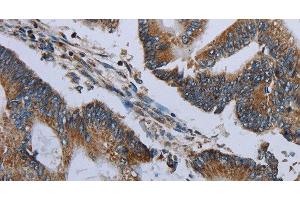 Immunohistochemistry of paraffin-embedded Human colon cancer using NDUFA13 Polyclonal Antibody at dilution of 1:50 (NDUFA13 antibody)