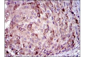 Immunohistochemical analysis of paraffin-embedded liver cancer tissues using CRP mouse mAb with DAB staining. (CRP antibody)