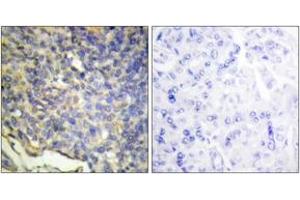 Immunohistochemistry analysis of paraffin-embedded human breast carcinoma tissue, using DFFA Antibody.
