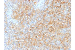 Formalin-fixed, paraffin-embedded human Hodgkins Lymphoma stained with CD40 Mouse Monoclonal Antibody (C40/1605). (CD40 antibody)