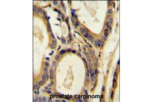 CCL4 Antibody immunohistochemistry analysis in formalin fixed and paraffin embedded human prostate carcinoma followed by peroxidase conjugation of the secondary antibody and DAB staining.