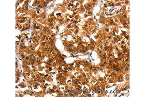 Immunohistochemistry of Human lung cancer using ADAP1 Polyclonal Antibody at dilution of 1:60