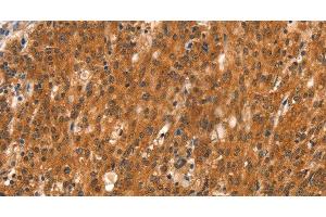 Immunohistochemistry of paraffin-embedded Human gasrtic cancer tissue using DAB2IP Polyclonal Antibody at dilution 1:40 (DAB2IP antibody)