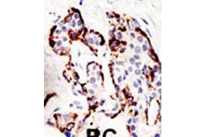 Formalin-fixed and paraffin-embedded human cancer tissue reacted with the primary antibody, which was peroxidase-conjugated to the secondary antibody, followed by DAB staining. (SUV39H2 antibody  (N-Term))