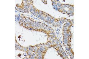 Immunohistochemistry of paraffin-embedded human colon carcinoma using MT-CYB antibody (ABIN7268595) at dilution of 1:100 (40x lens). (Cytochrome b antibody)