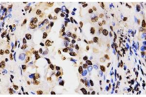 Immunohistochemistry of paraffin-embedded Human lung cancer using Asymmetric DiMethyl-Histone H3-R17 Polyclonal Antibody at dilution of 1:200 (40x lens). (Histone 3 antibody  (H3R17me2a))