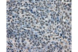 Immunohistochemical staining of paraffin-embedded Adenocarcinoma of ovary tissue N93ing anti-ARNT mouse monoclonal antibody. (ARNT antibody)