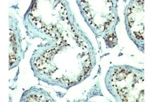 Formalin-fixed, paraffin-embedded human testicular carcinoma stained with Nucleolin antibody.