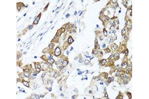 Immunohistochemistry of paraffin-embedded Human colon carcinoma using PPOX Polyclonal Antibody at dilution of 1:100 (40x lens). (PPOX antibody)