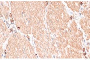 Immunohistochemistry of paraffin-embedded Human gastric cancer using ABCB7 Polyclonal Antibody at dilution of 1:100 (40x lens). (ABCB7 antibody)
