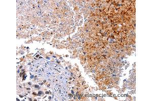 Immunohistochemistry of Human lung cancer using HMOX1 Polyclonal Antibody at dilution of 1:40 (HMOX1 antibody)