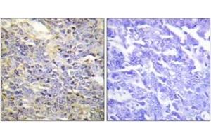 Immunohistochemistry analysis of paraffin-embedded human lung carcinoma tissue, using Caspase 9 (Ab-125) Antibody.