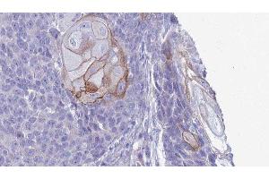 ABIN6279758 at 1/100 staining Human Head and neck cancer tissue by IHC-P.