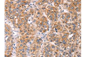 The image on the left is immunohistochemistry of paraffin-embedded Human liver cancer tissue using ABIN7191466(MLNR Antibody) at dilution 1/45, on the right is treated with synthetic peptide. (Motilin Receptor antibody)